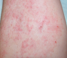 image showing eczema